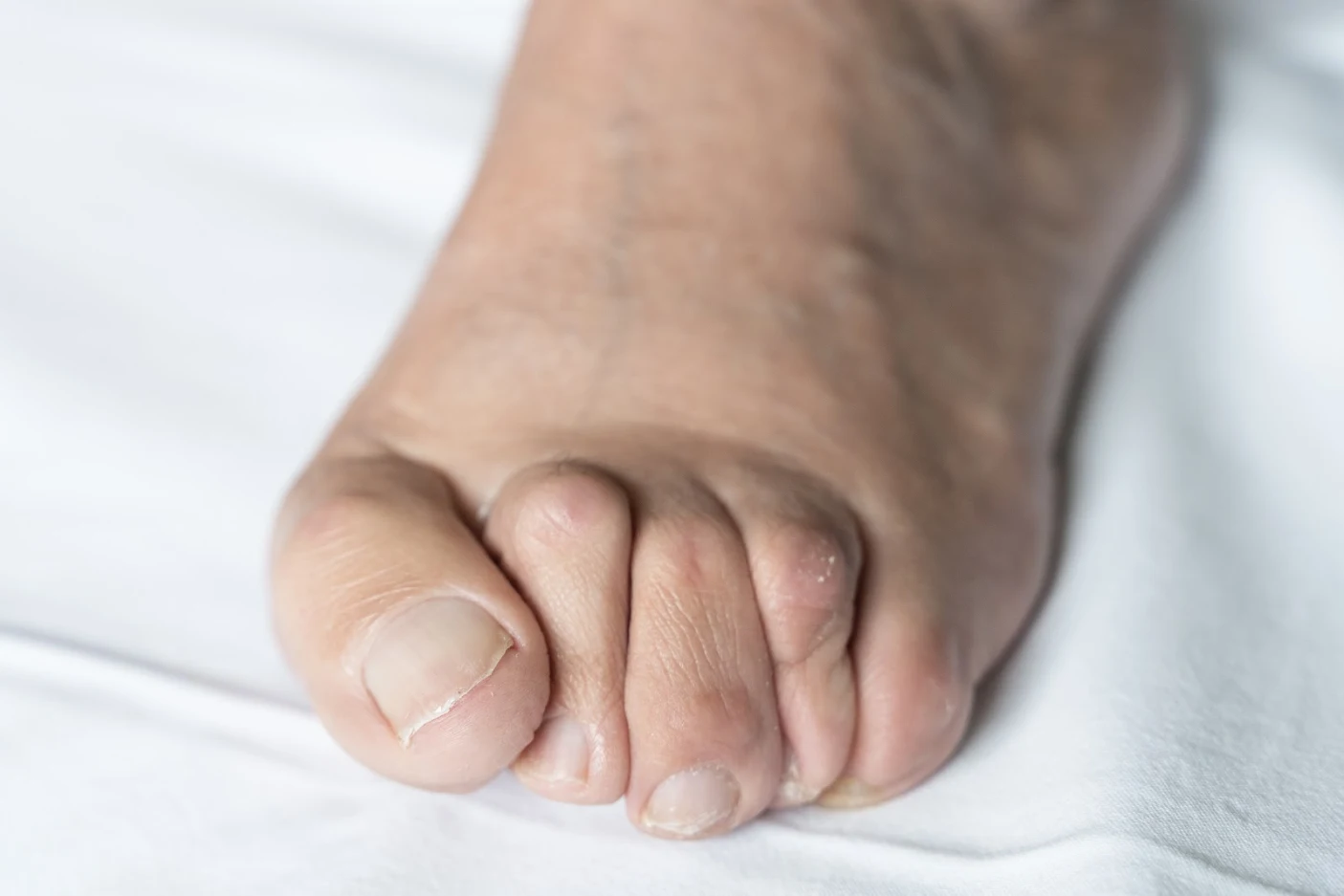 Minimally Invasive Hammertoe Surgery