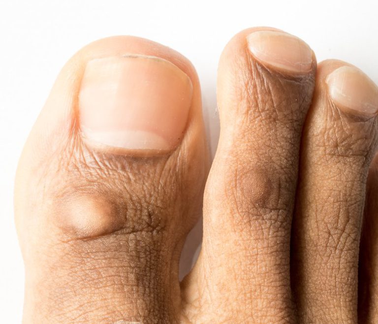 Corn Removal Surgery Miami Luxe Foot Surgery