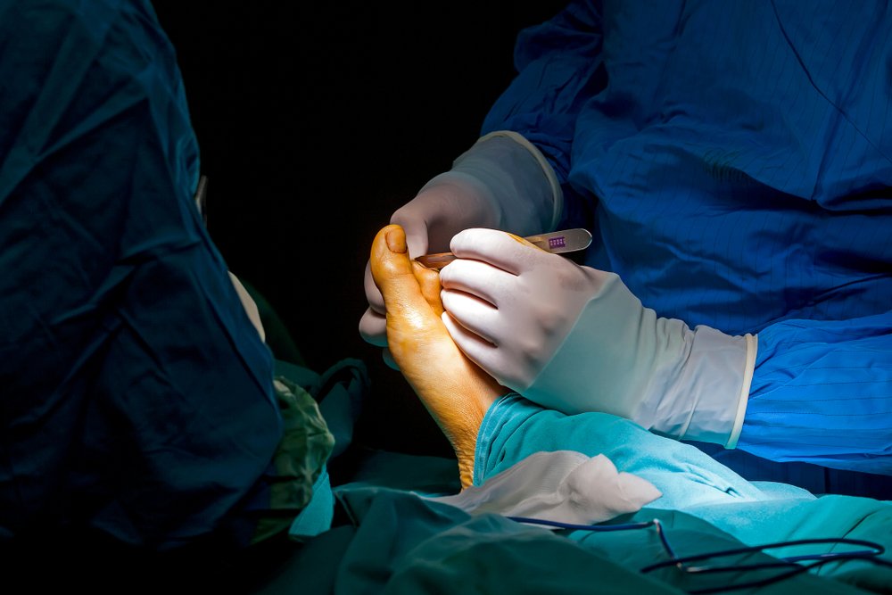 Minimally Invasive Hammertoe Surgery