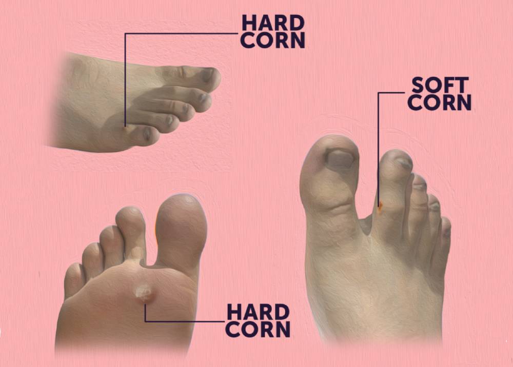 Types of foot Corns