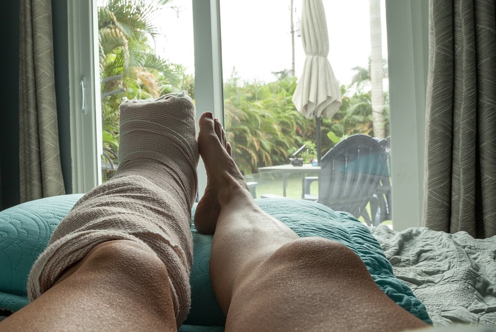Woman Recovery after Minimally Invasive Bunion Surgery