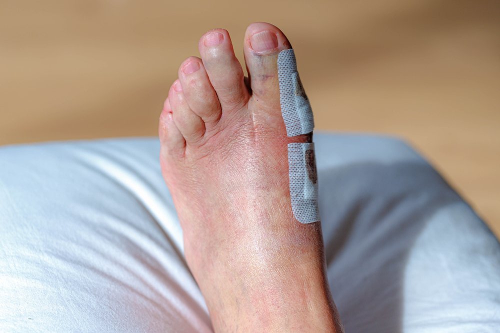 foot after Minimally Invasive Bunion Surgery