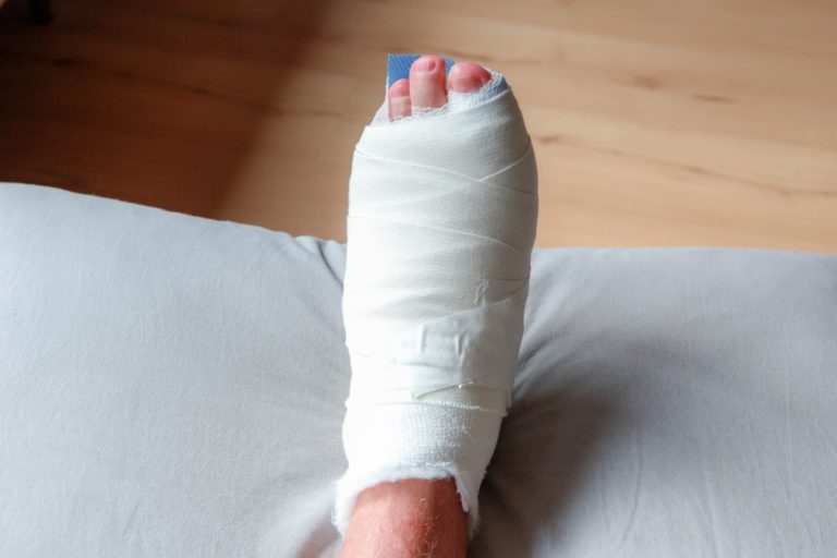Everything You Need to Know About Bunion Surgery Recovery