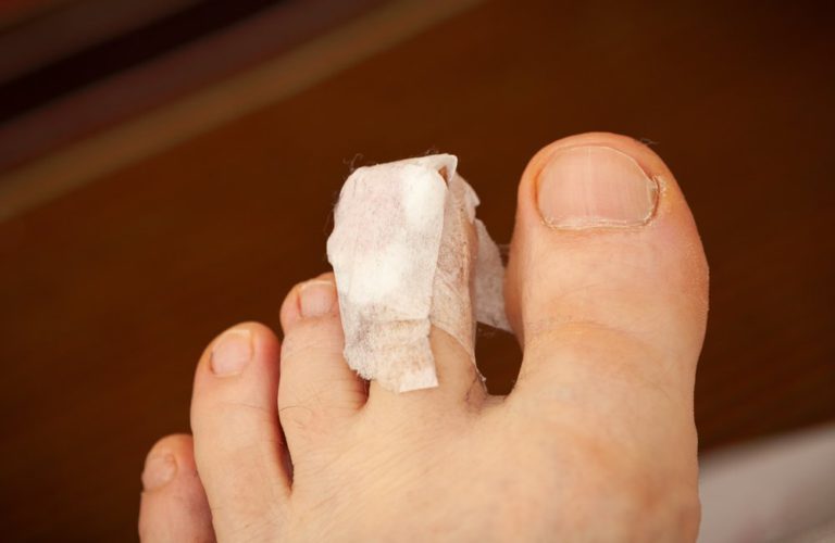 Toe Shortening Surgery Recovery Time