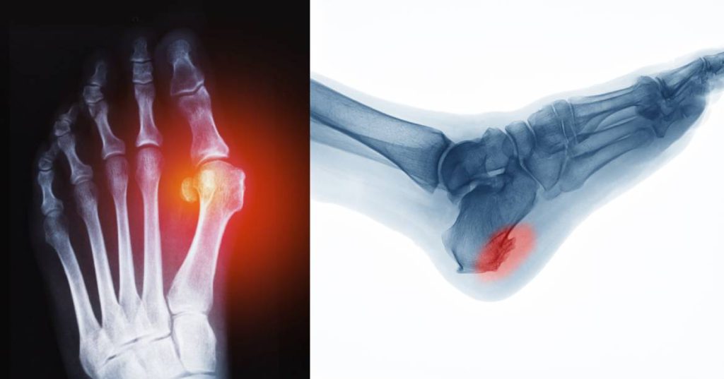 Bunion vs. Bone Spur