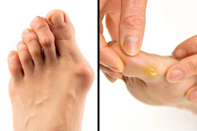 Bunion vs. Callus
