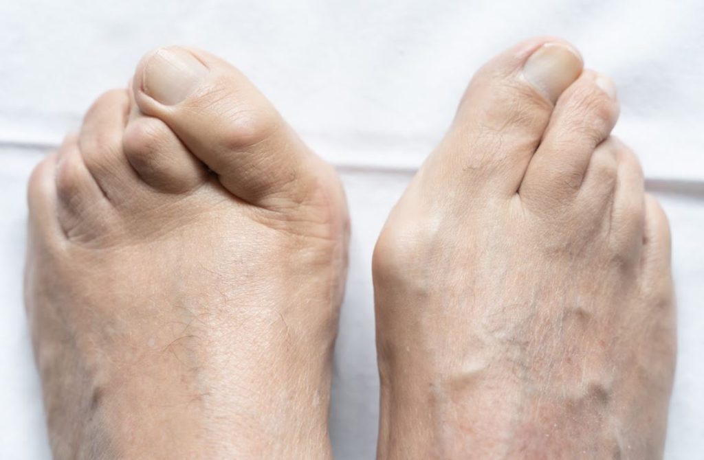 Minimally Invasive Hammertoe Surgery