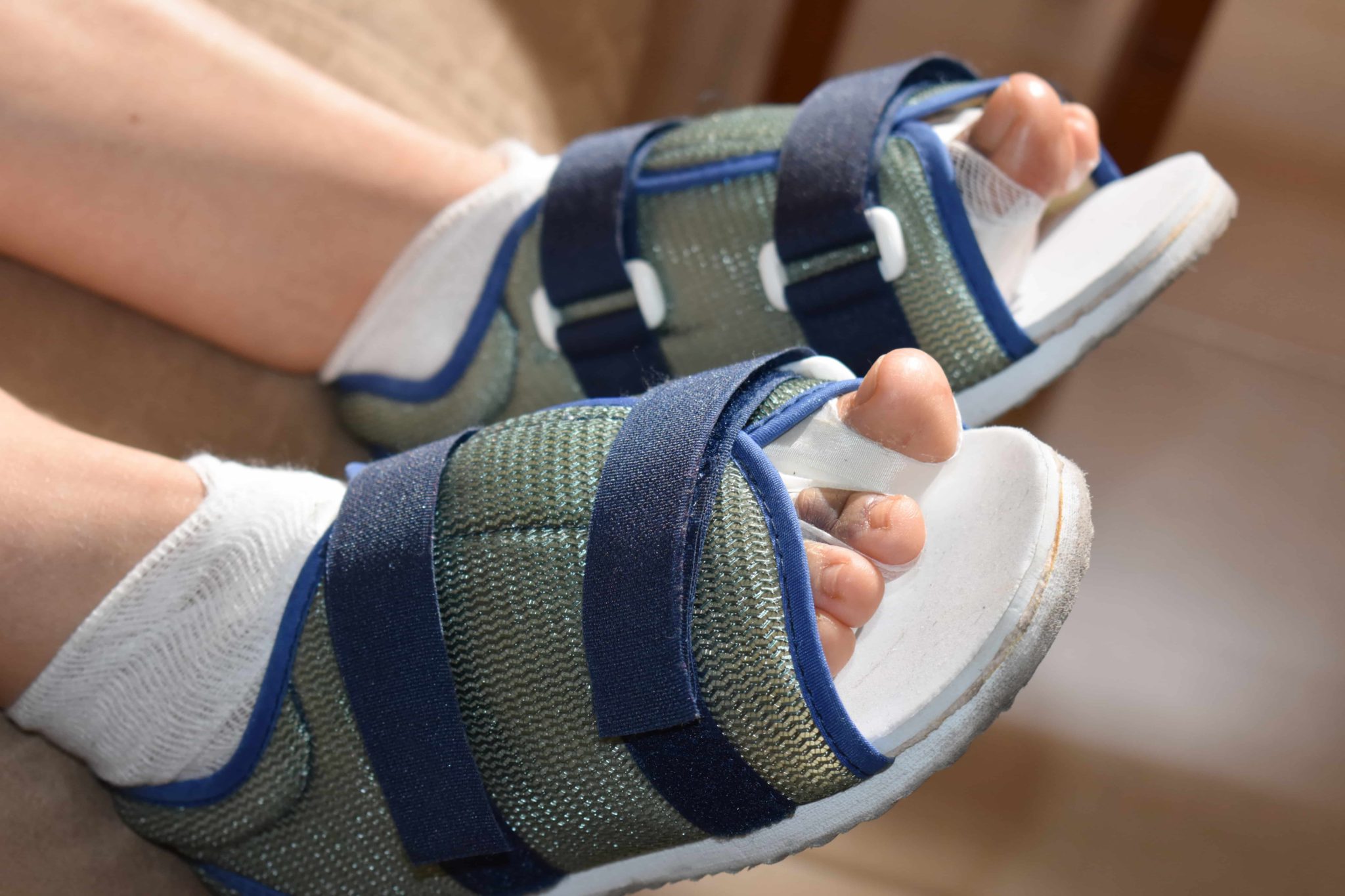 Why do I need to wear the postop shoe all the time after hammertoe surgery? Luxe Foot Surgery