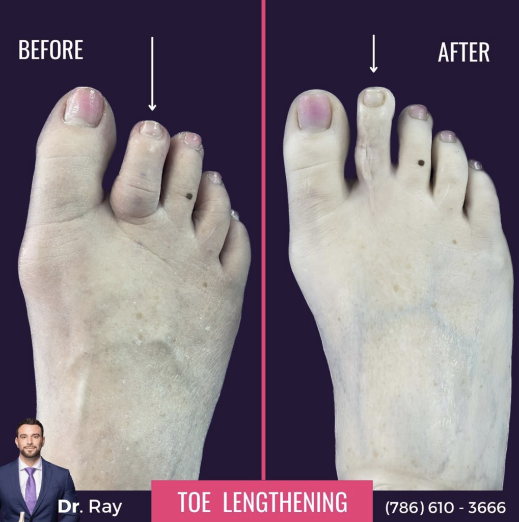 Toe Lengthening Surgery Miami