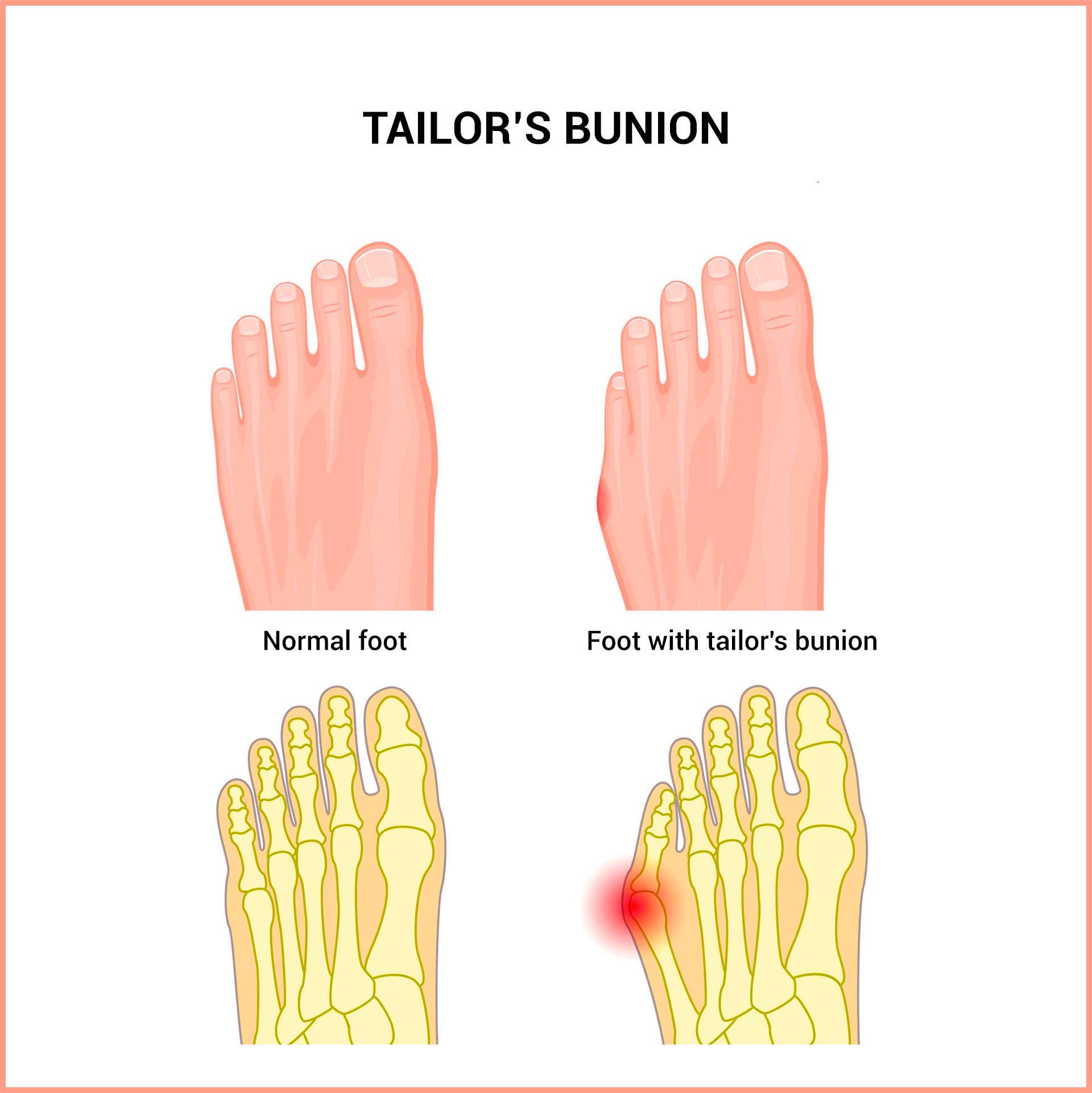 Tailor Bunion Surgery Miami Expert Care for Foot Pain Relief