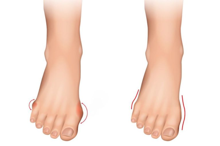 Bilateral Tailor Bunion Surgery