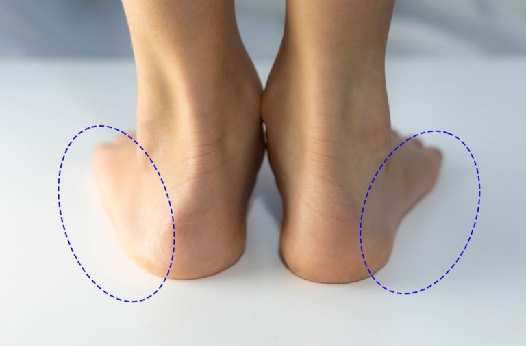 How Much Is Flat Feet Surgery?