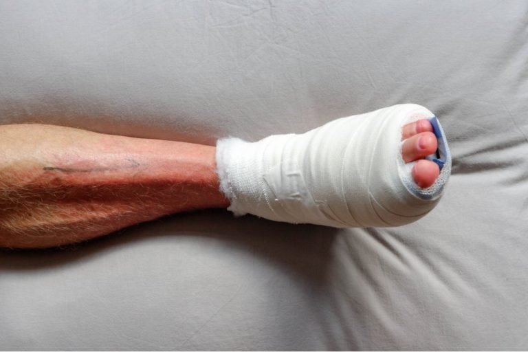 Bunion Surgery Gone Wrong