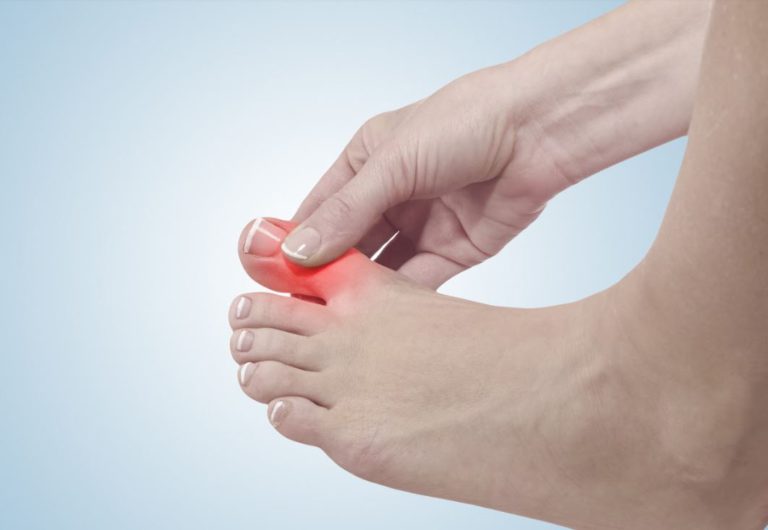 Toe Drift After Bunion Surgery