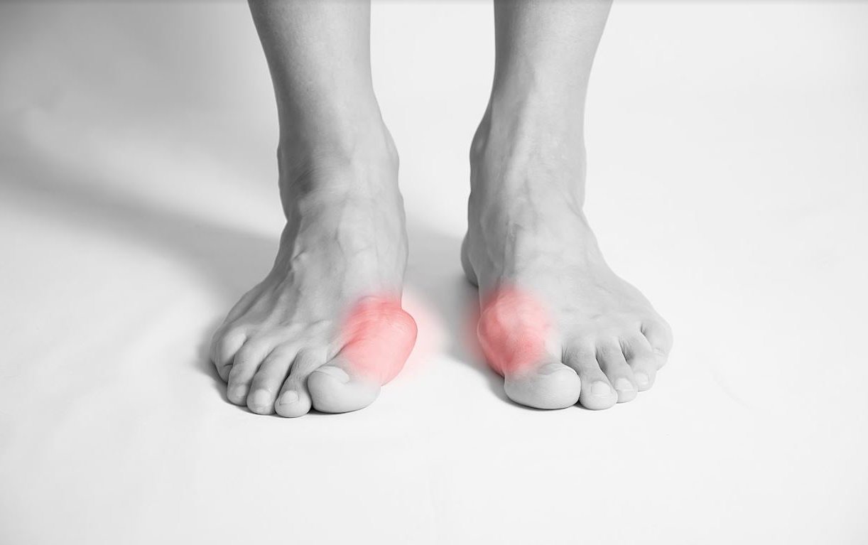 Bunion Surgery on Both Feet