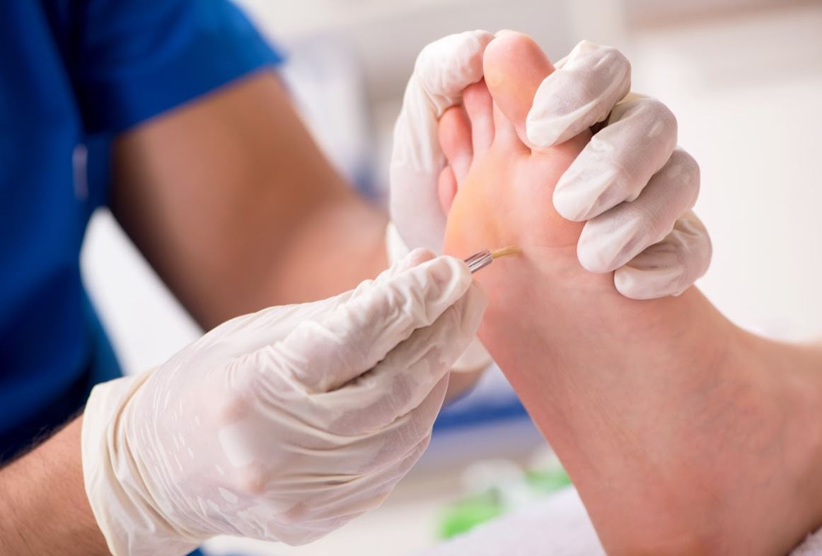 Inside of a Corn on Foot Understanding the Anatomy of a Corn and How