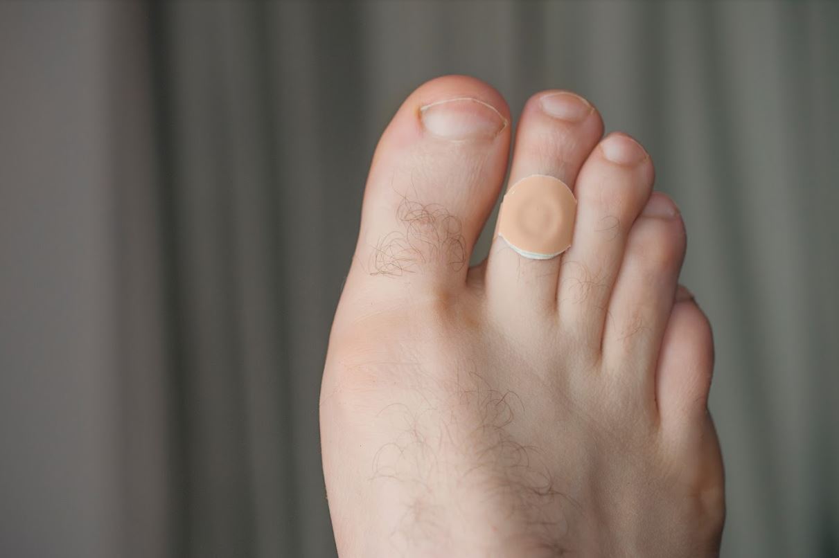 How to Treat a Corn on the Side of my Foot?