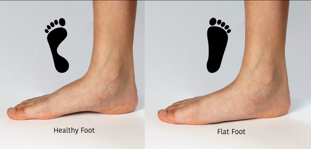 Anatomy of normal feet and flat feet