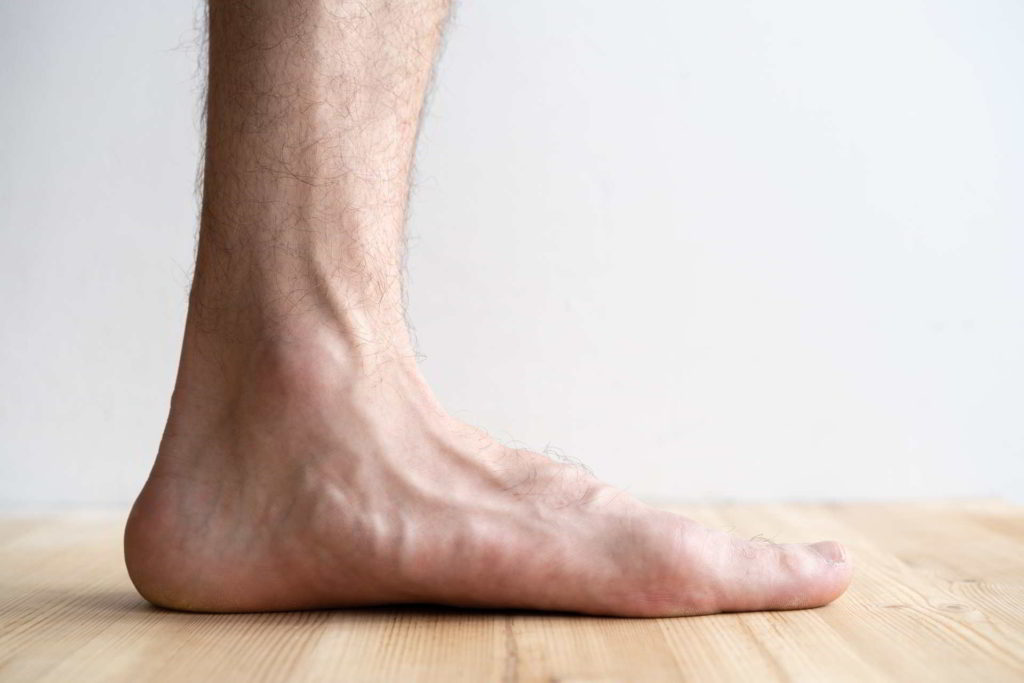 Benefits of flat feet surgery