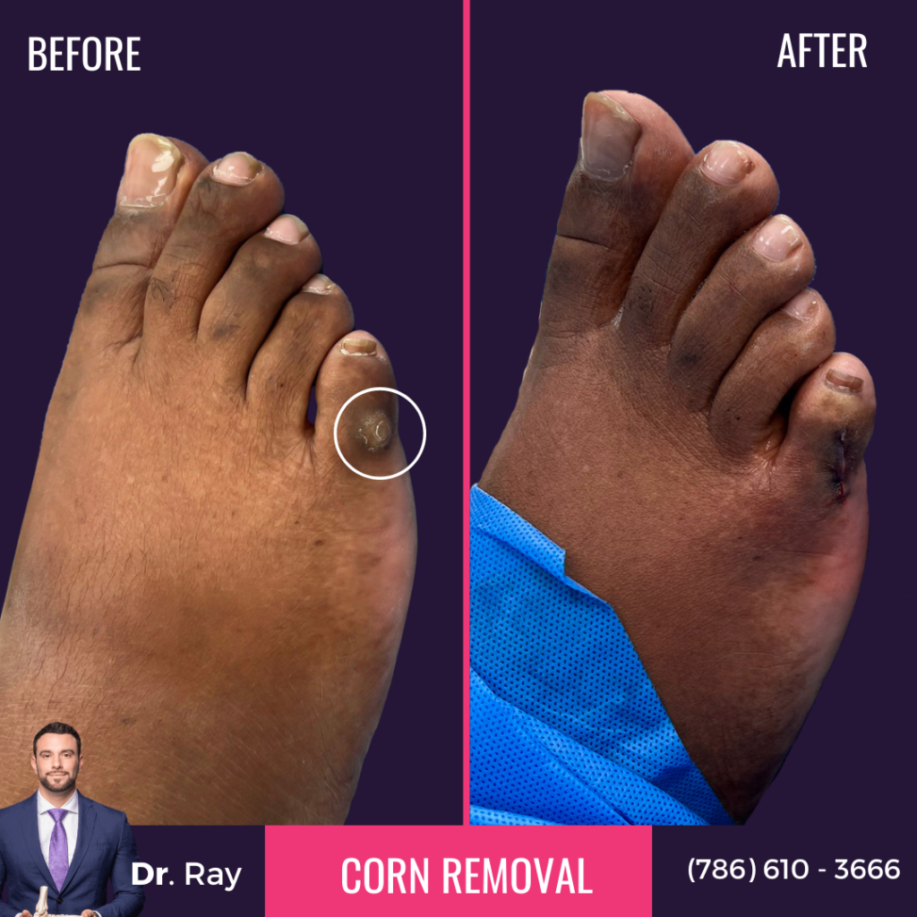 Corn Removal Surgery Before and After Picture