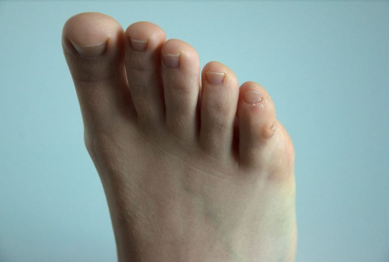 Foot Corn on Toe Causes and Treatment Options for Corns on the Toes