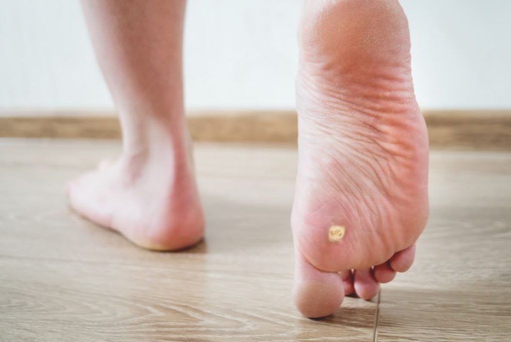 Corn or Wart on the Bottom of the Foot