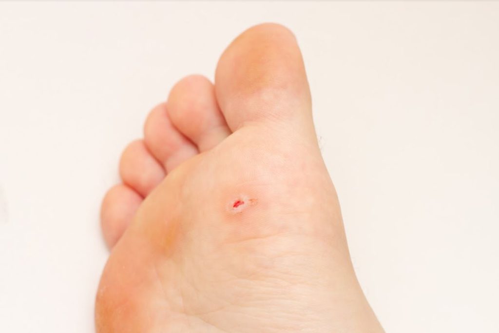 Foot Corn Symptoms How to Recognize and Treat Corns on the Feet