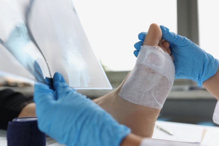 Best Sandals for Bunions and Flat Feet