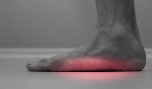 How to Fix Flat Feet With Surgery