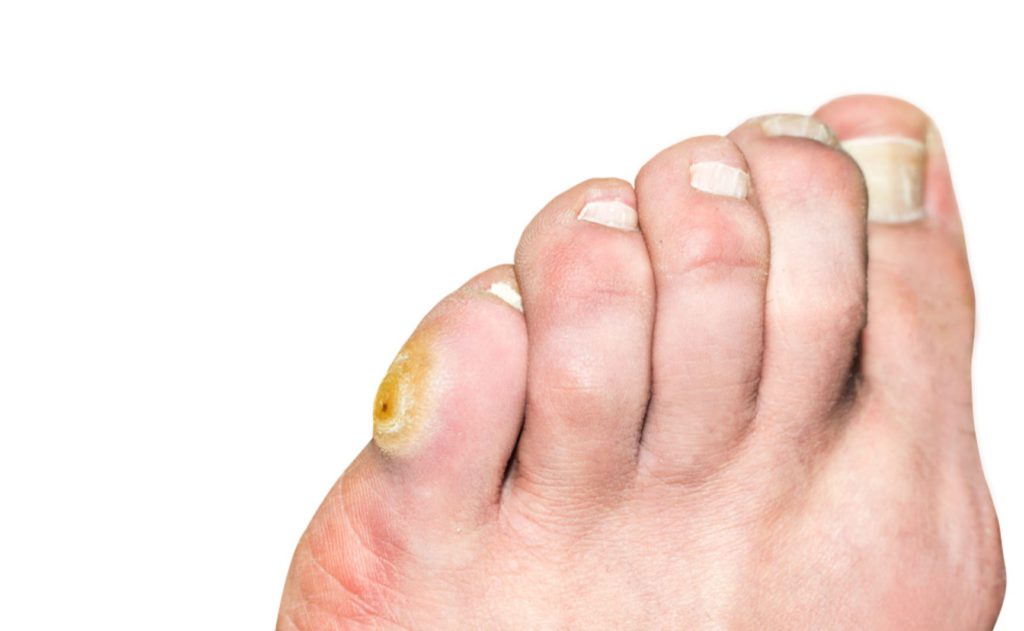 How to Get Rid of a Corn on Your Toe Tips and Techniques for Corn Removal