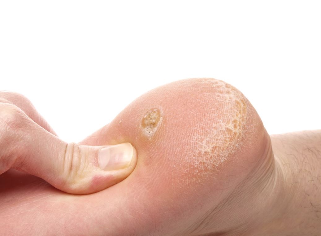 How to Remove Calluses