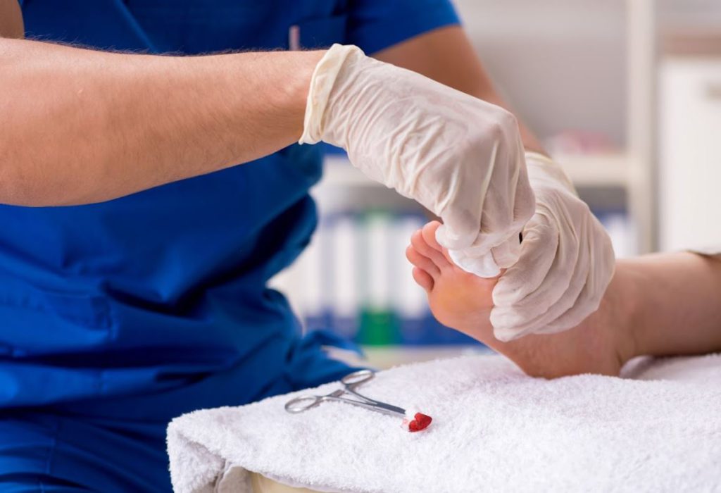 Understanding Foot Corn Surgery Benefits, Risks, and Recovery