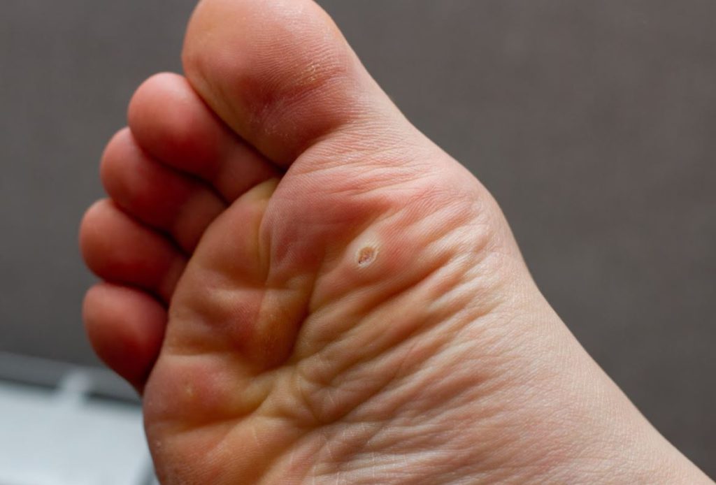 What is a Seed Corn on a Foot? Understanding the Causes and Symptoms of Corns