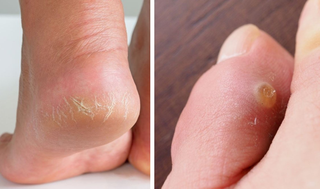 Corn Removal Surgery Miami Luxe Foot Surgery