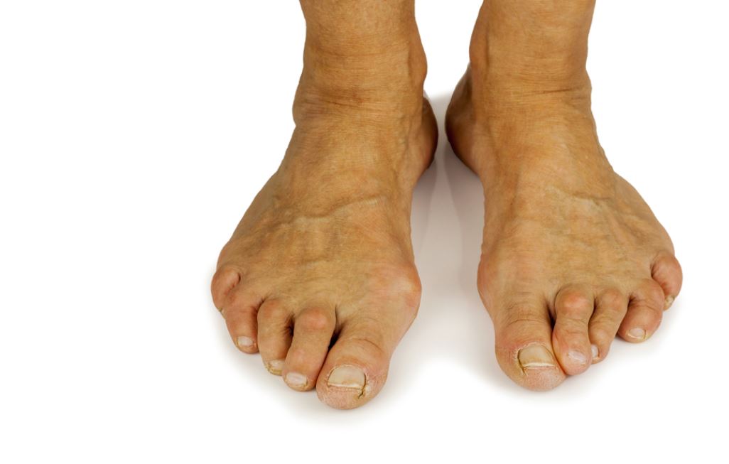 Get Relief with Claw Toe Surgery in Miami from 5000
