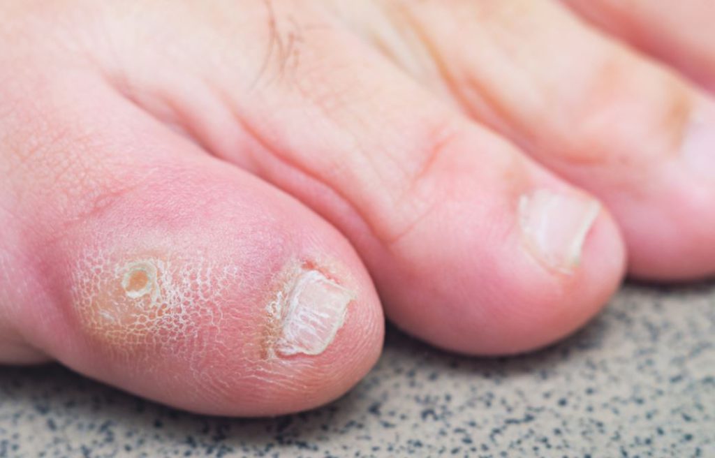 A Guide to Hard Movable Corn on Toes