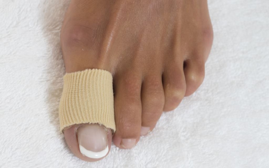 Do Corns on the Top of Toes Require Surgery