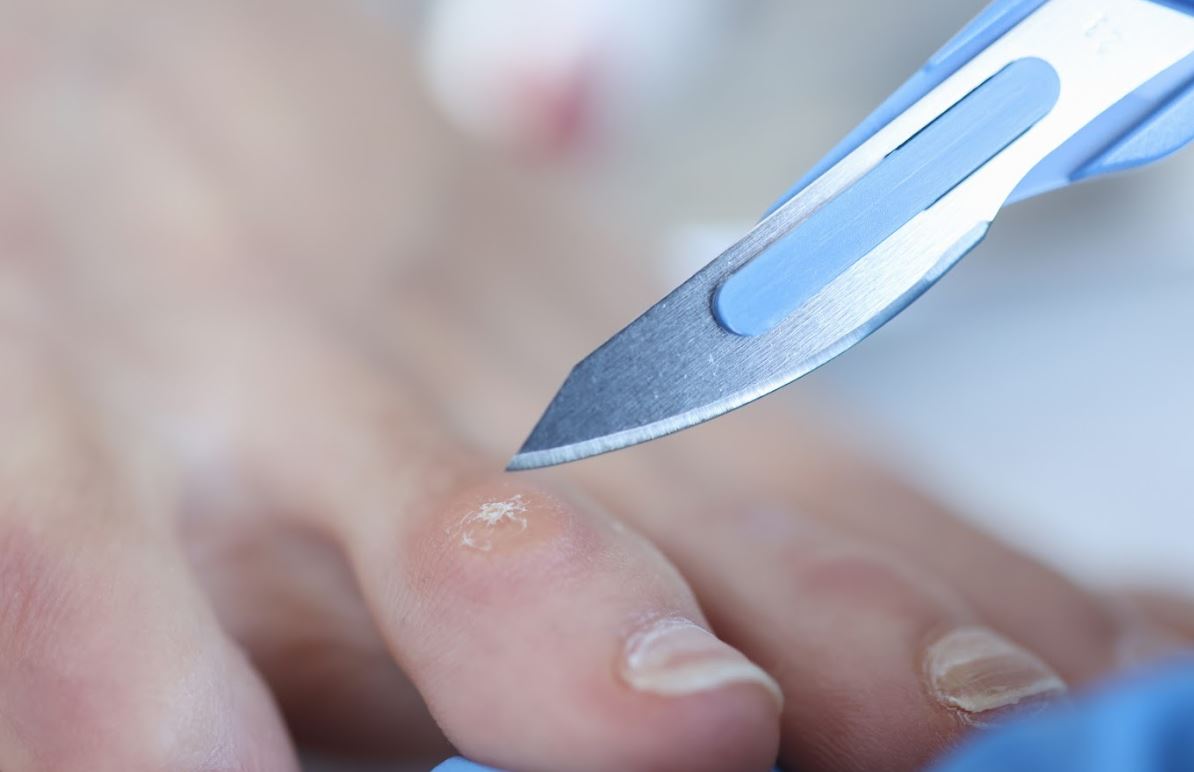 How to Treat Corns on the Toes