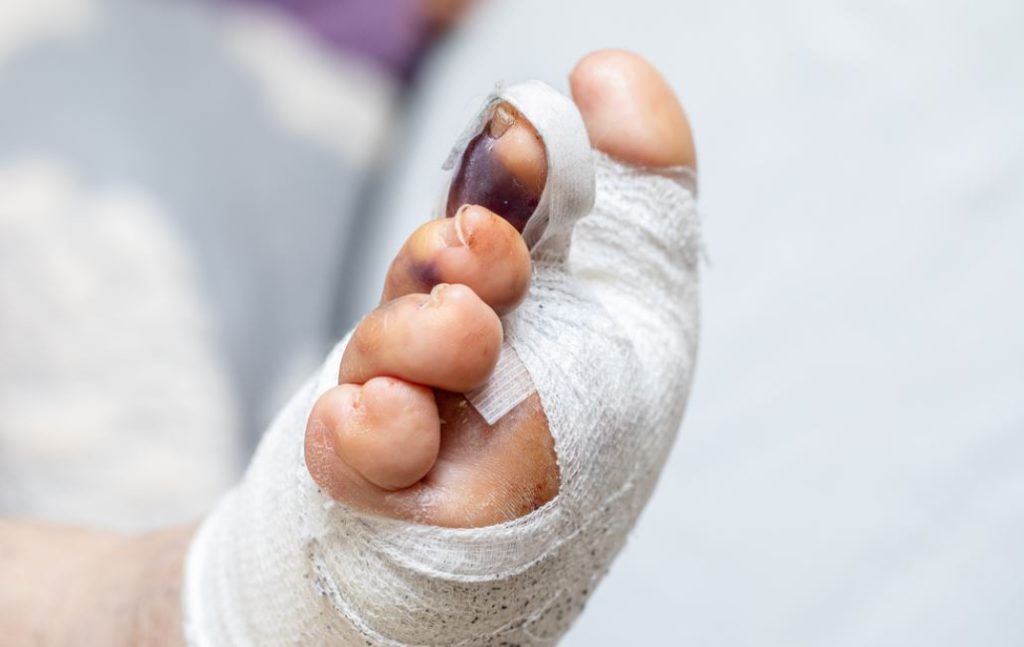 Does Toe Lengthening Surgery Hurt