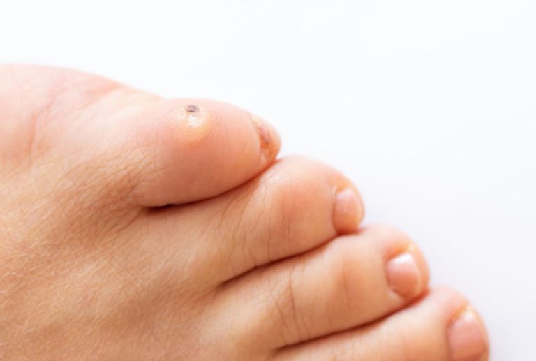 Hard Corn Deformity on Right Little Toe