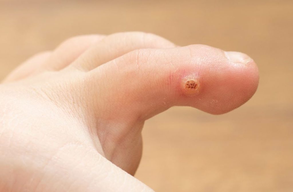 All About Heloma Molle Soft Corn Between Toes