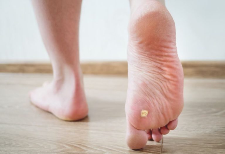 How to Remove Seed Corns on Bottom of Feet?