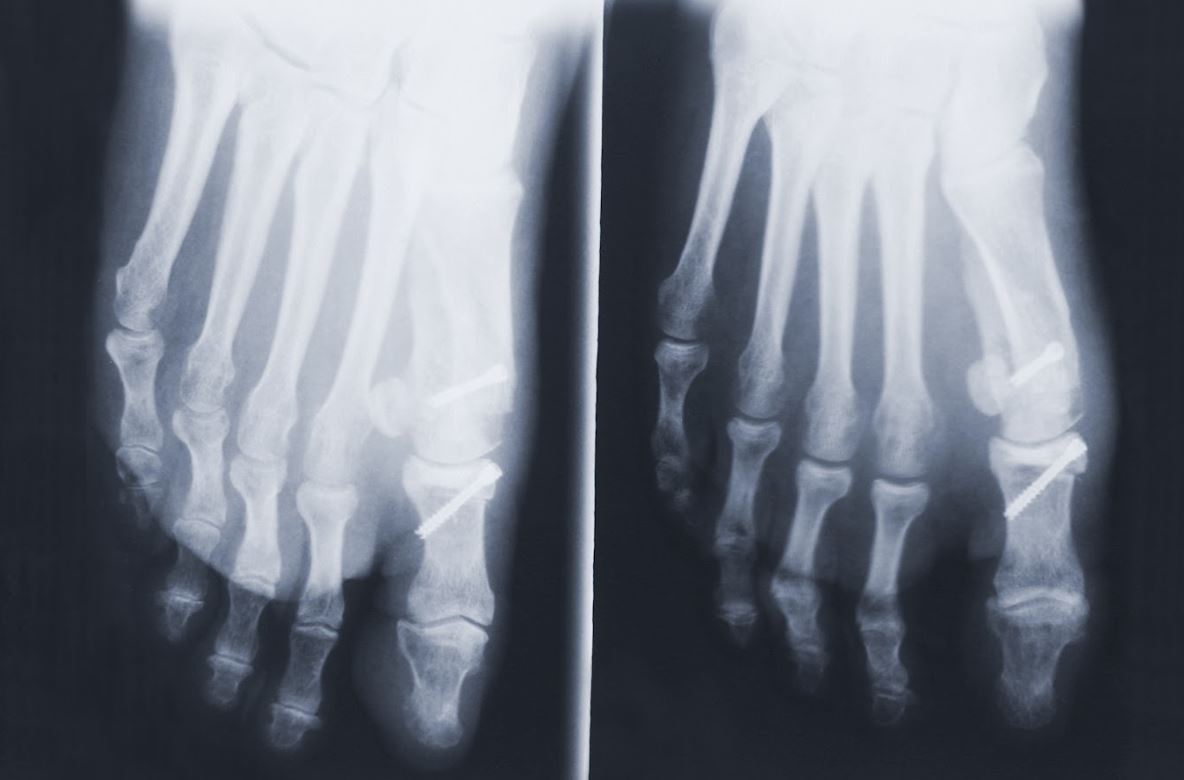 What Are Big Toe Surgery Options