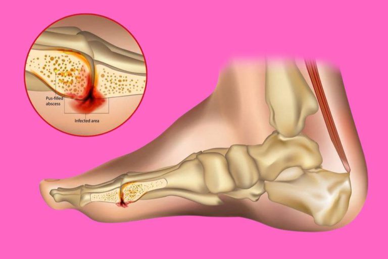 Toe Shortening Surgery