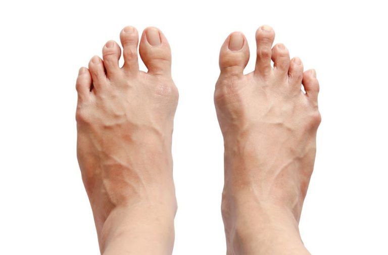 Toe Shortening Surgery