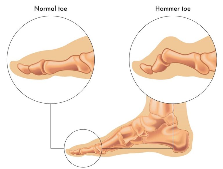 Minimally Invasive Hammertoe Surgery