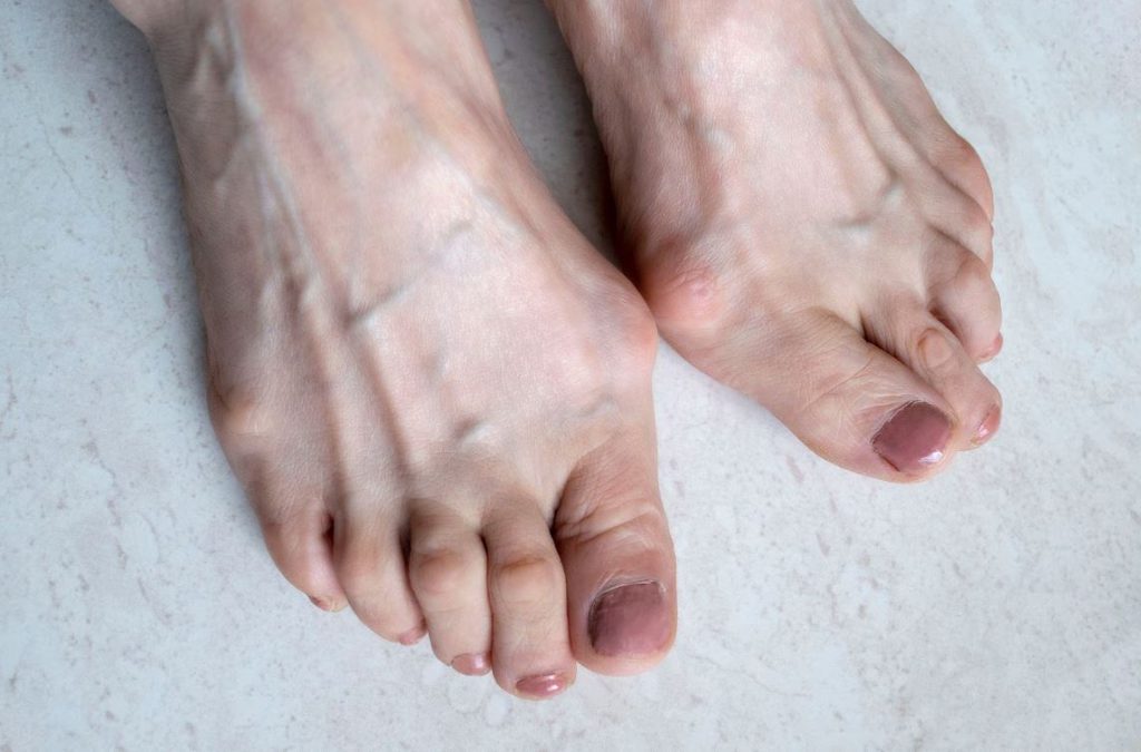A pair of feet with hammertoes