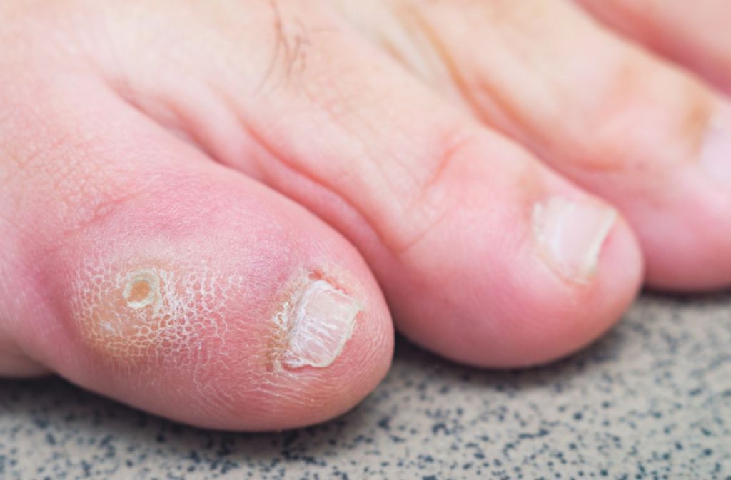 How Does a Podiatrist Remove a Corn?