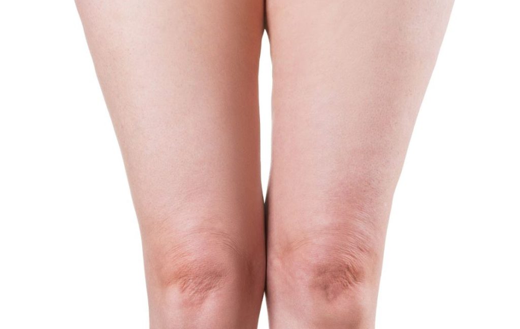 Saggy Knee Skin Causes, Treatment, and Prevention