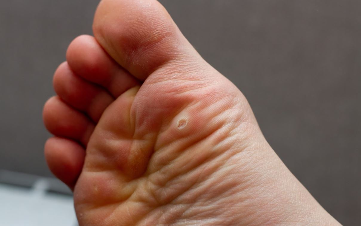 Corn Surgery Recovery Ensure a Smooth Healing Process